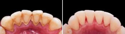 Close up of back of lower front teeth before and after removing plaque