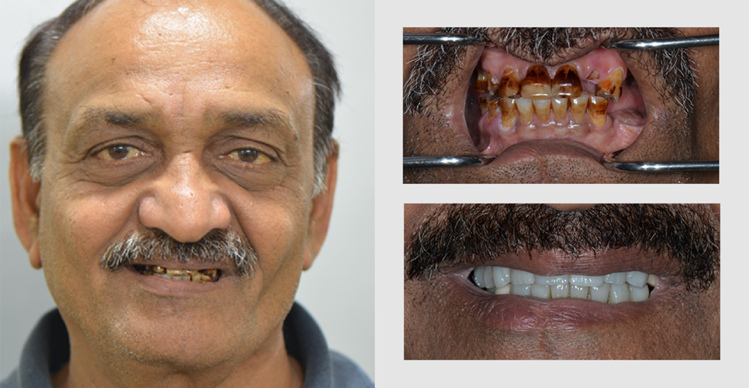 Before and after pictures of man with mustache