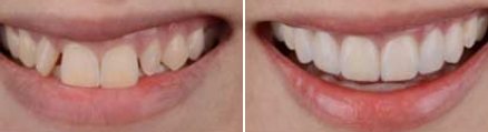 Smile before and after straightening and whitening teeth