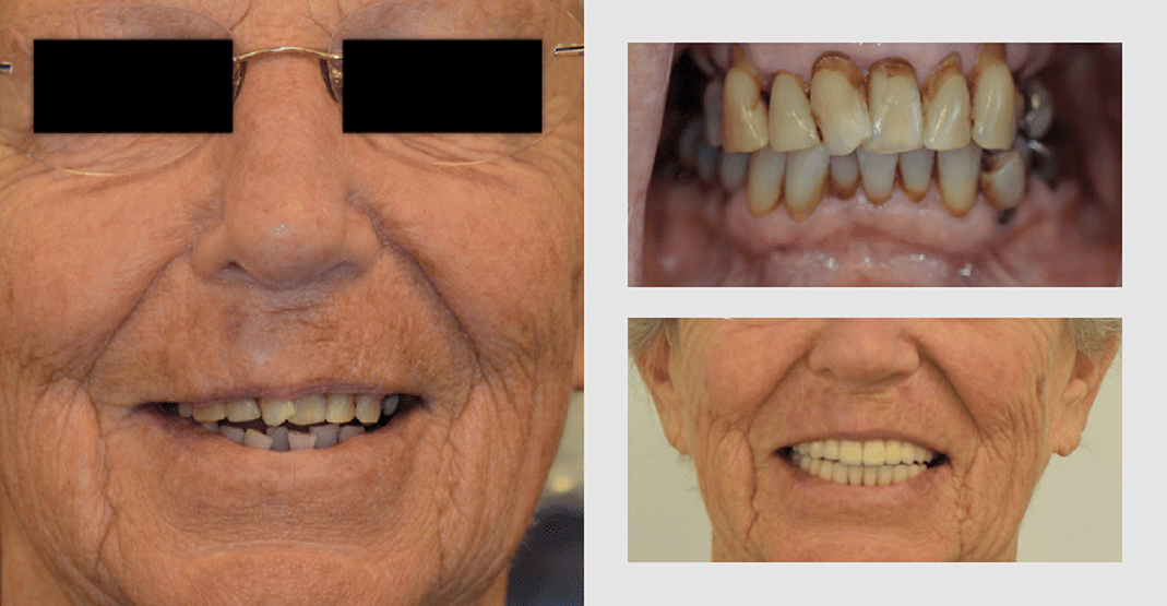 Before and after pictures of man with crooked teeth