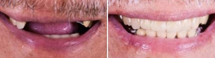 Man smiling before and after replacing upper arch of teeth