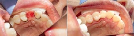 Close up of upper row of teeth before and after replacing a missing tooth