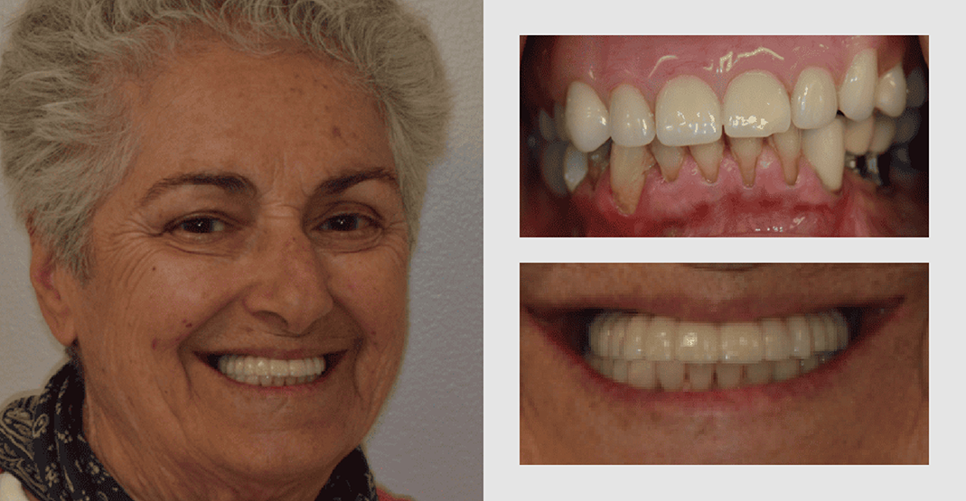 Before and after pictures of older woman with white hair