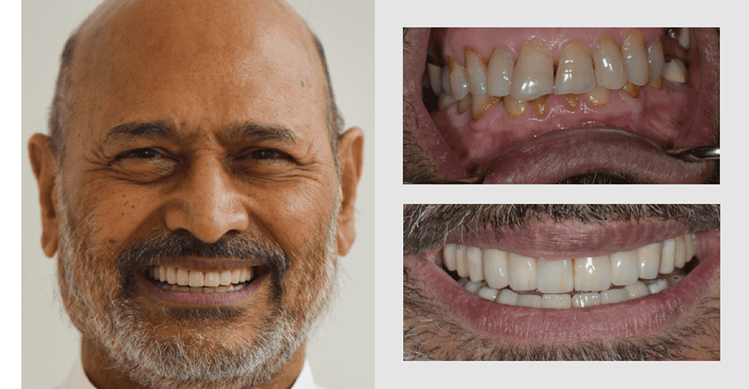 Before and after pictures of man with facial hair