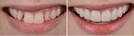 Smile before and after straightening and whitening teeth