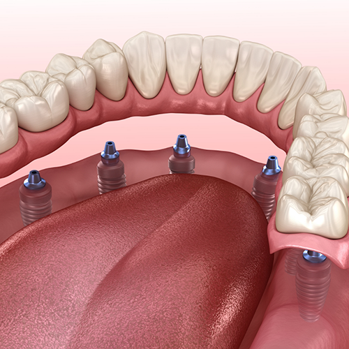 Illustration of dentures being attached to dental implants