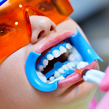 Woman opening mouth for professional teeth whitening