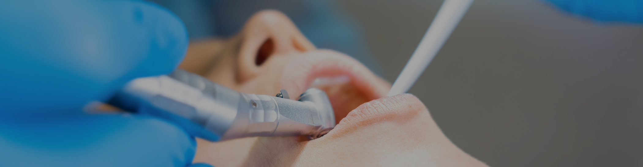 Patient opening mouth to receive tooth colored fillings in Richardson