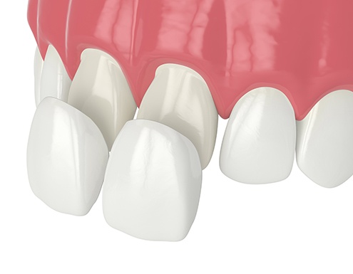 Illustration of veneers being placed on two front teeth