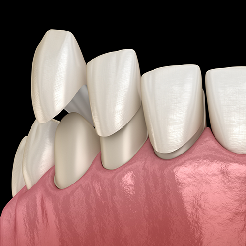 Illustration of veneers being attached to teeth