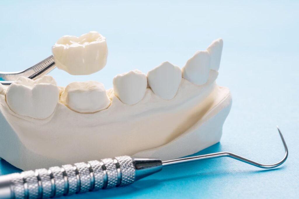 A dental crown being placed on a plaster model of a jaw