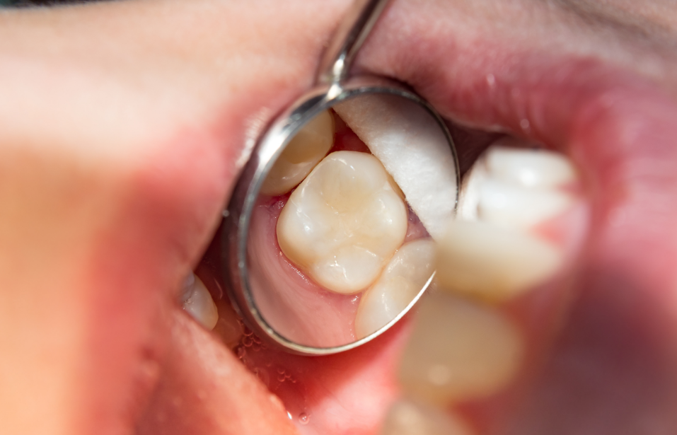 Close up of a filling