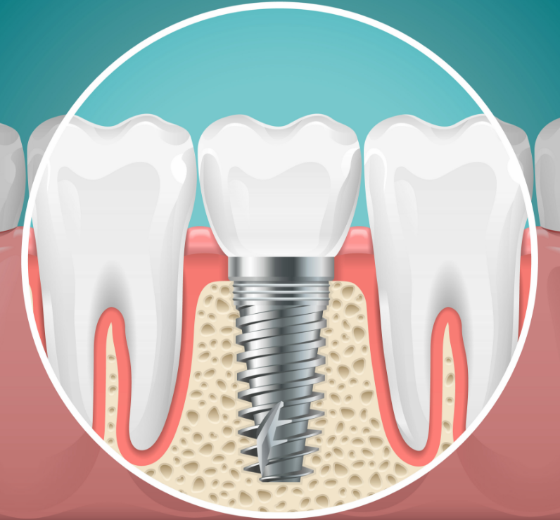 Illustrated cross section of a dental implant
