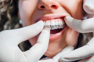 Gloved hands inserting Invisalign over woman's upper arch